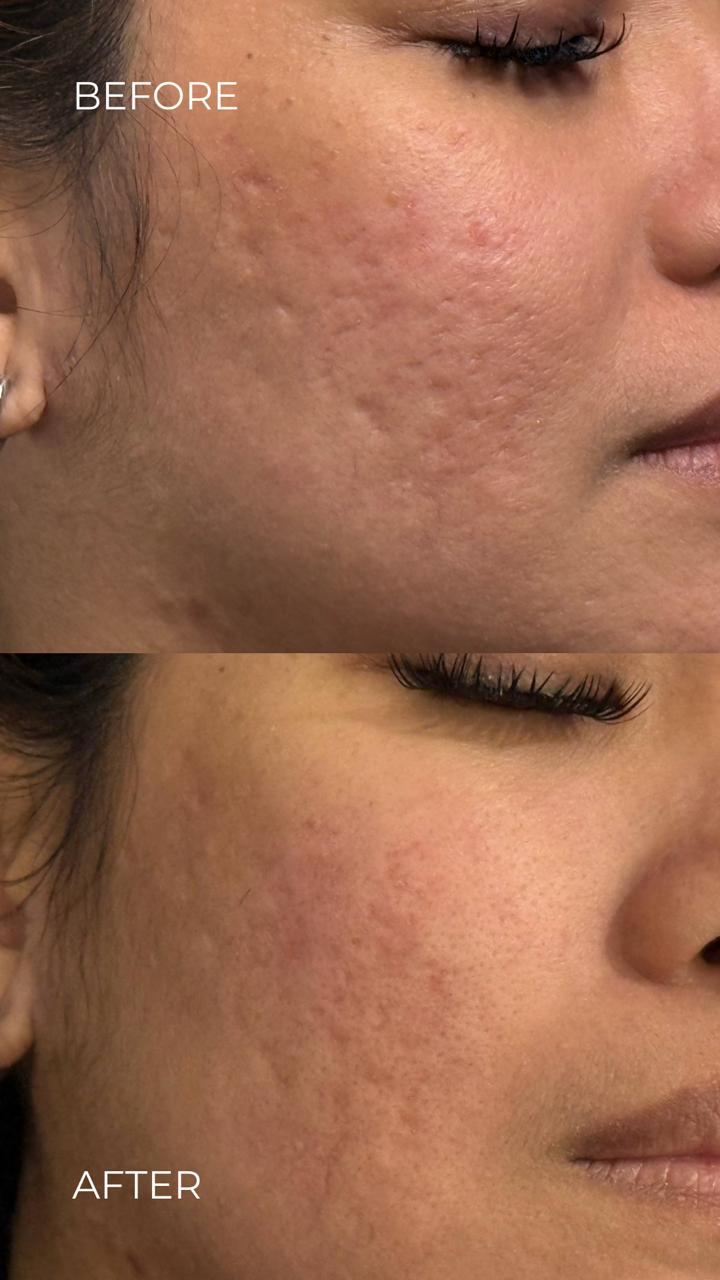 Acne scar revision after one session