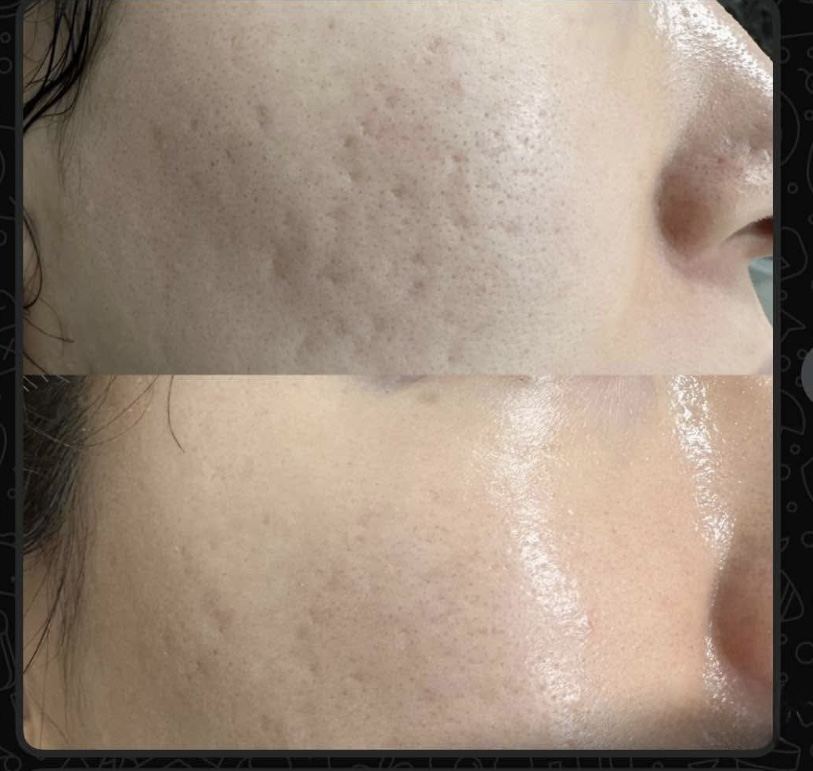 Acne scar texture revision before and after