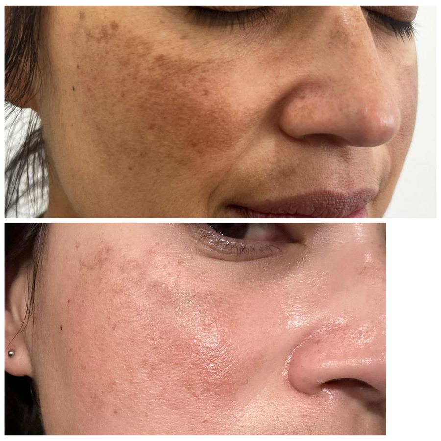 Pigmentation correction before and after on the cheek