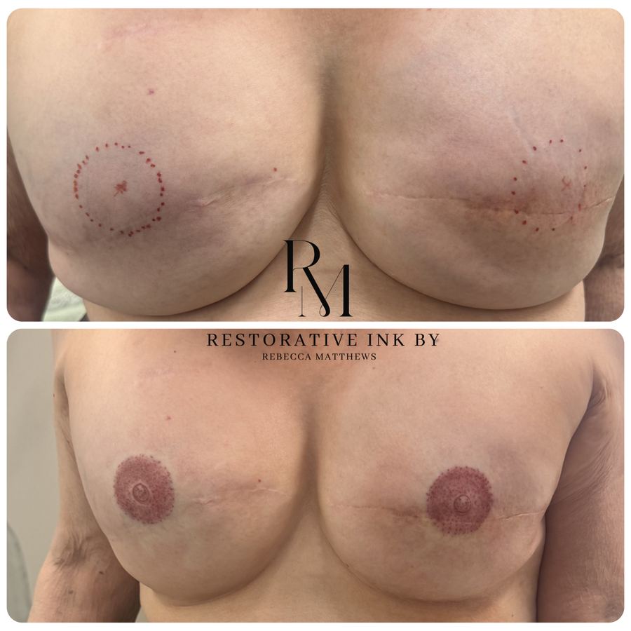 Bilateral 3D areola restoration after mastectomy, mapping to healed result