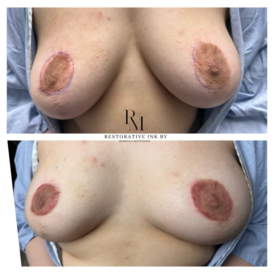 Periareolar scar camouflage and areola restoration after breast augmentation