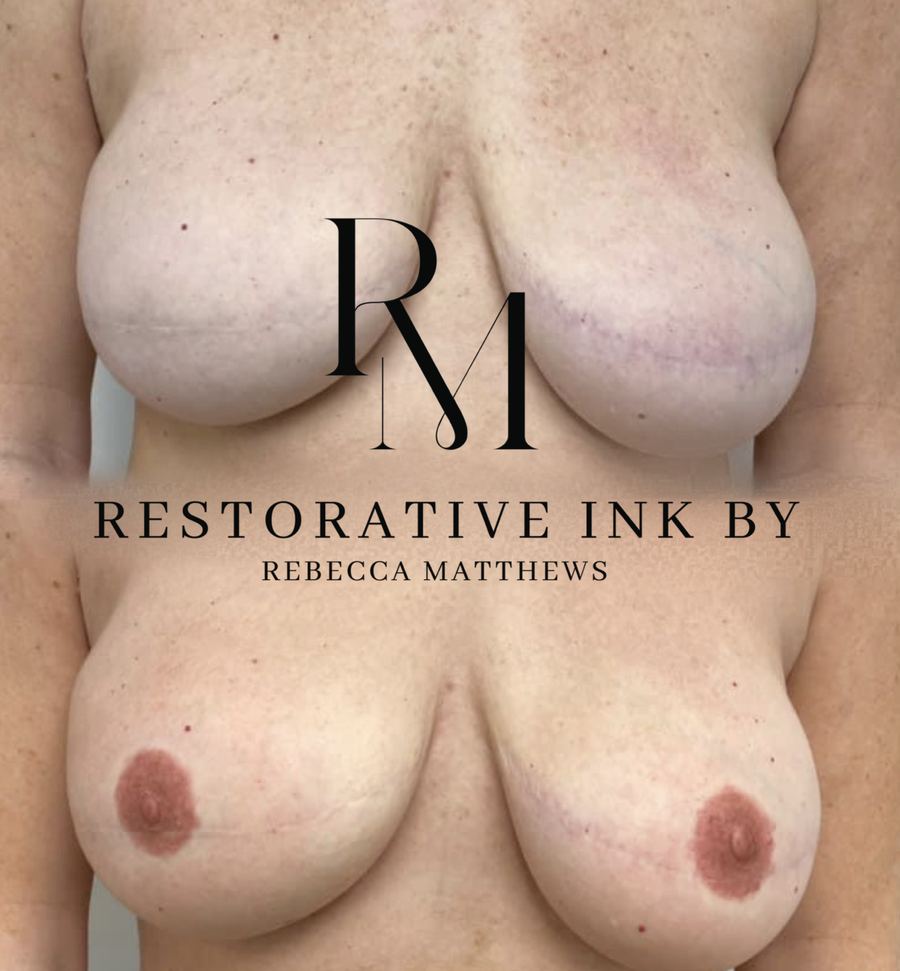Bilateral 3D areola restoration before and after
