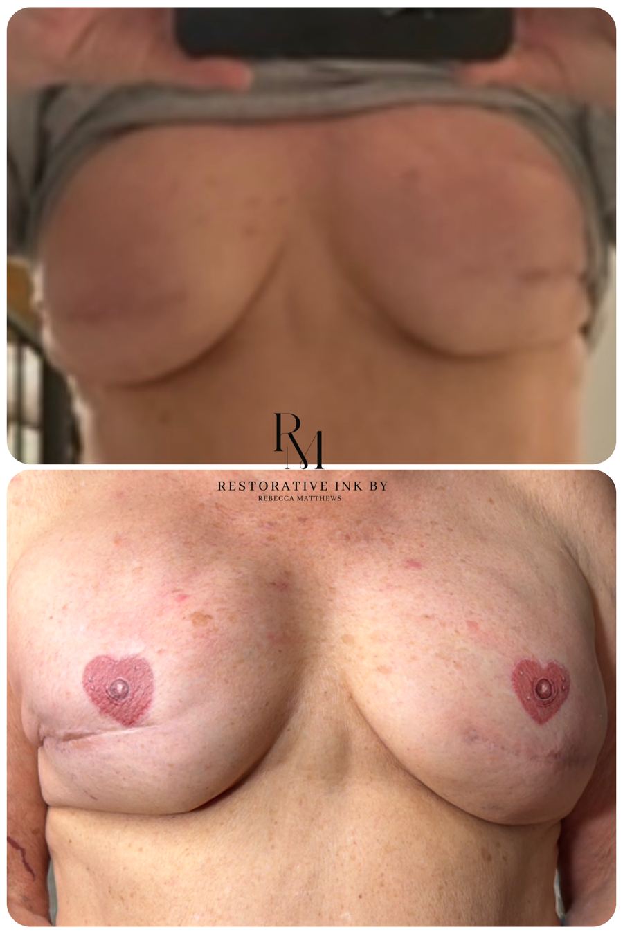 Heart-shaped 3D areola restoration before and after