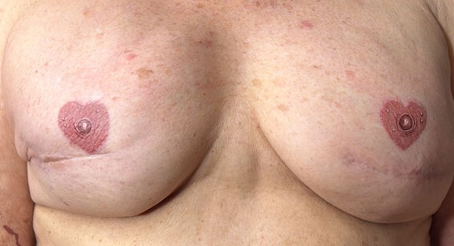 Healed heart-shaped 3D areolas after mastectomy reconstruction