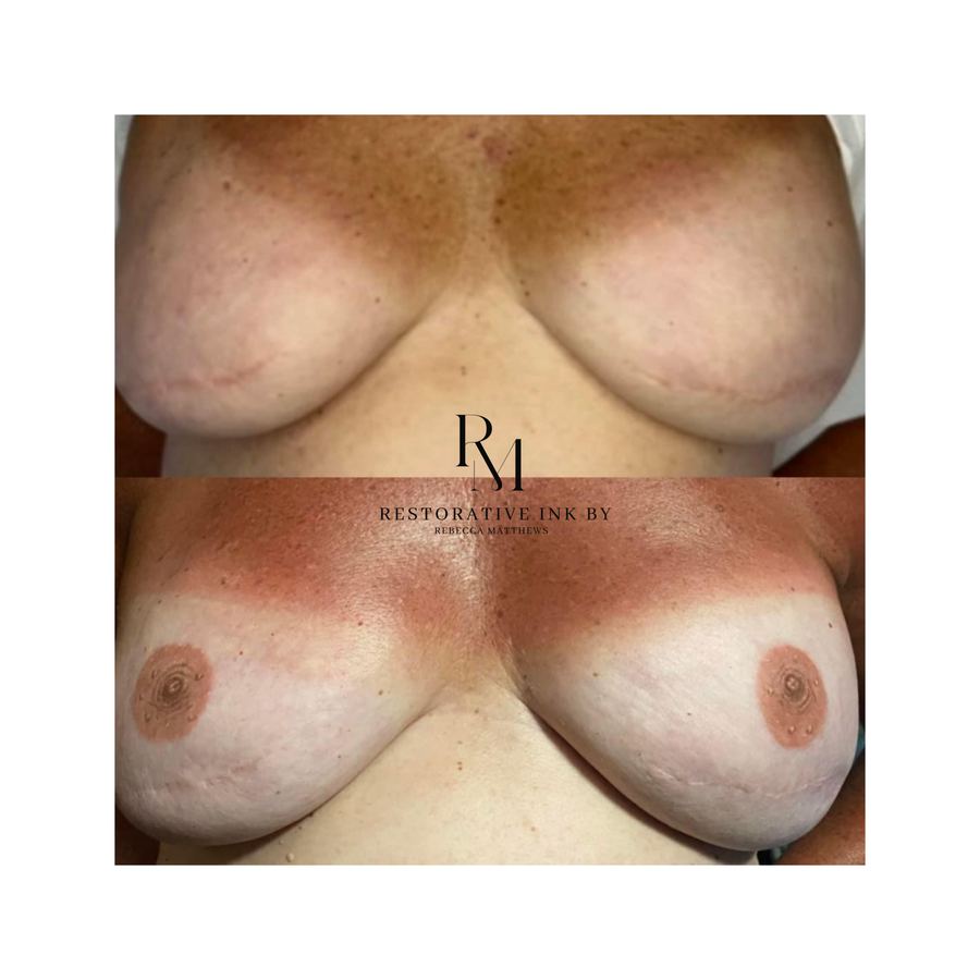 Bilateral 3D areola restoration after mastectomy, before and after