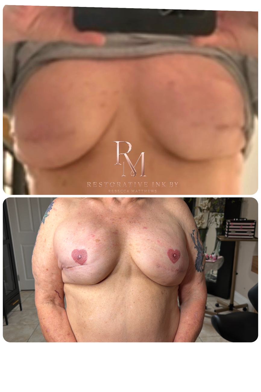 Heart-shaped areola restoration, bilateral, after mastectomy