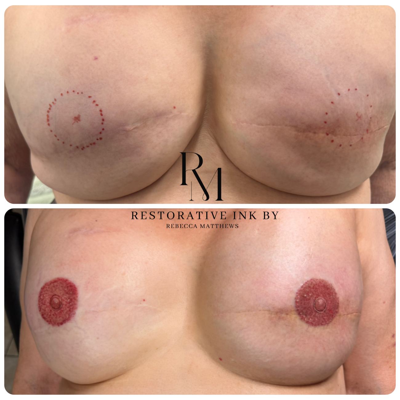 Bilateral 3D areola restoration after mastectomy, showing the mapping stencil and the completed work