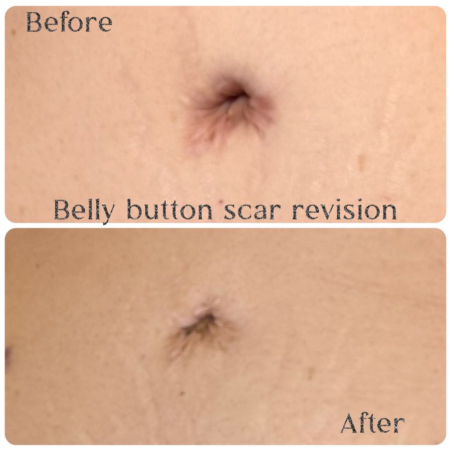 Belly button scar revision before and after