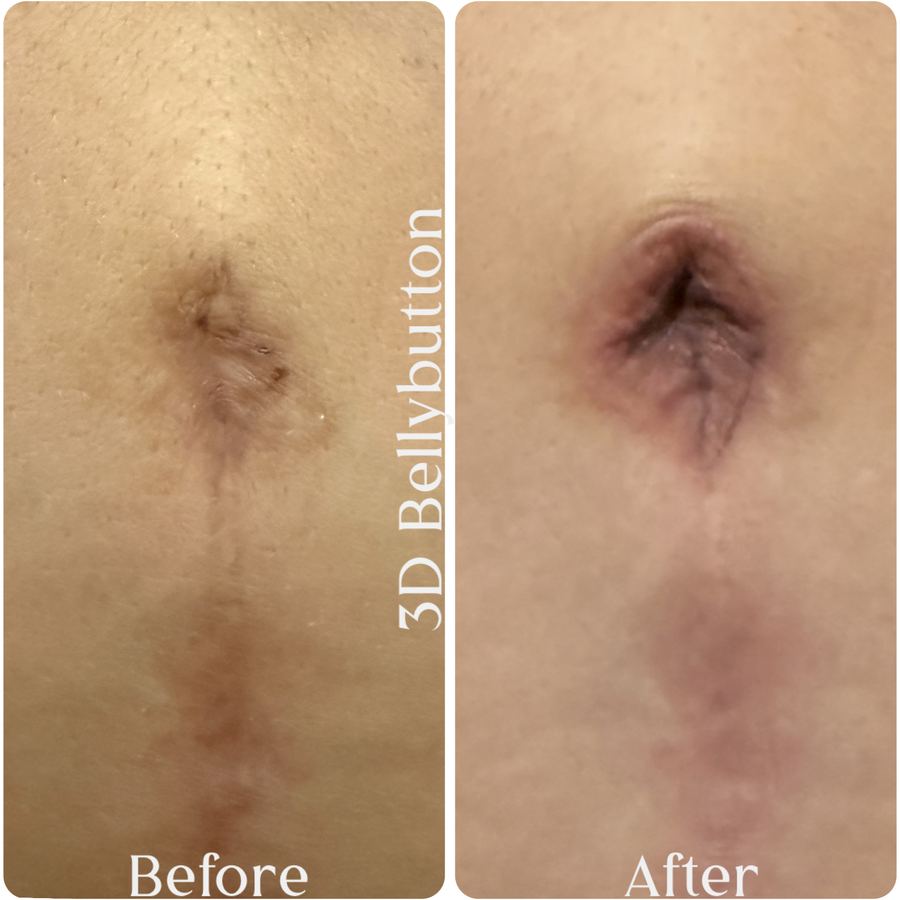 3D belly button restoration before and after