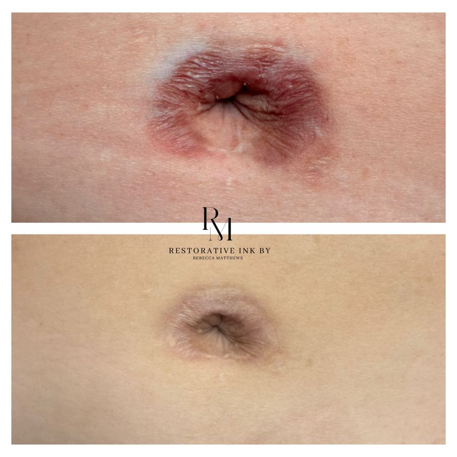 Belly button revision healed result, before and after