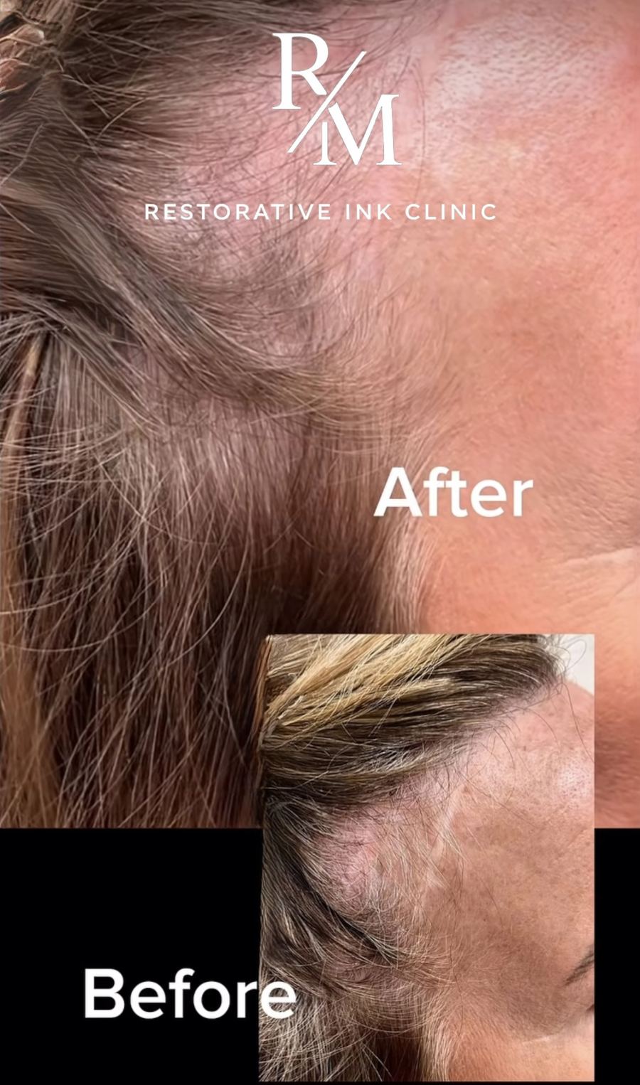 Facelift scar camouflage before and after at the temporal hairline