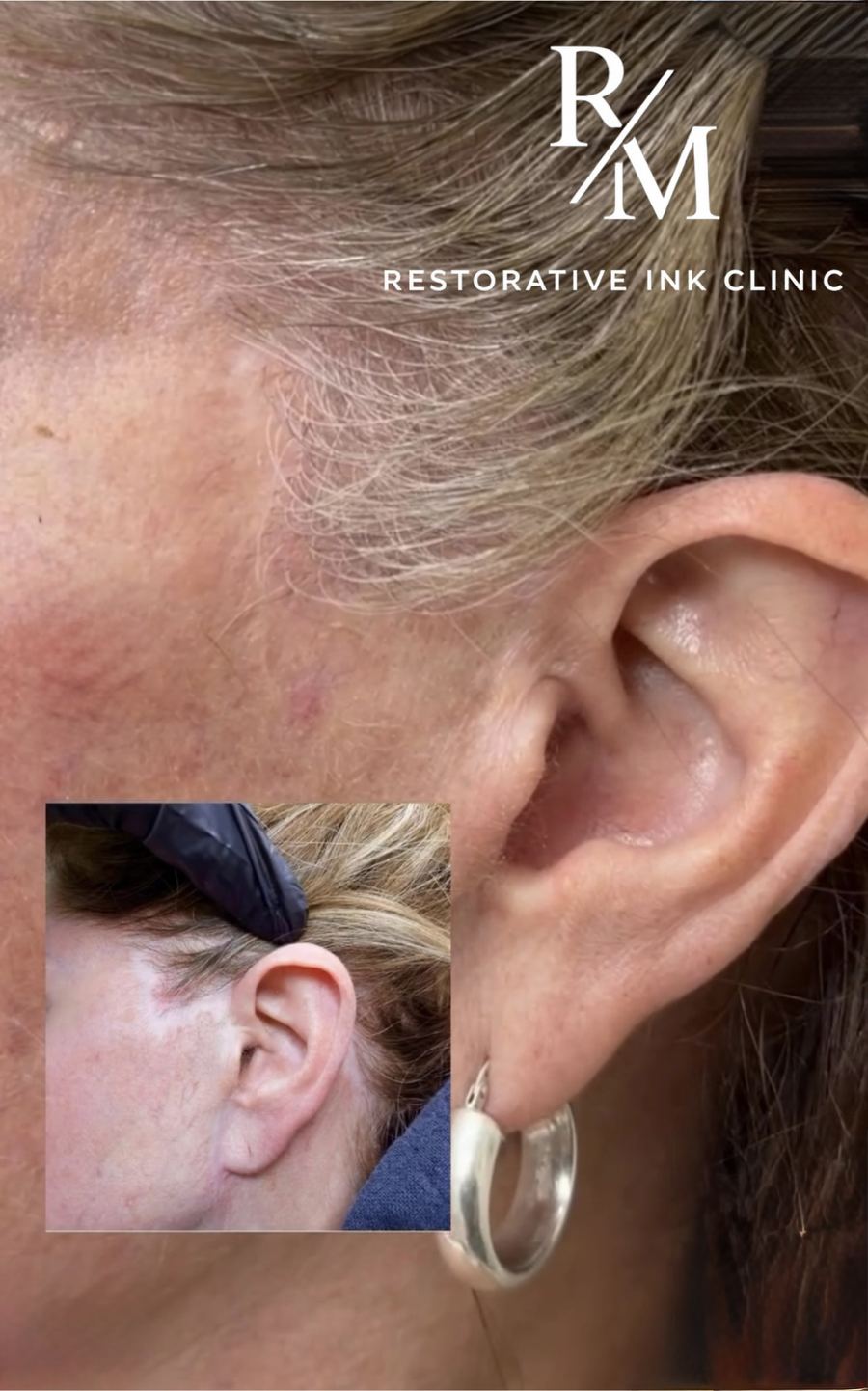 Facelift scar camouflage before and after in the periauricular area