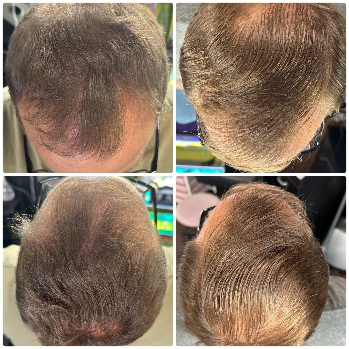 Hair follicle restoration before and after on the crown, shown from multiple angles