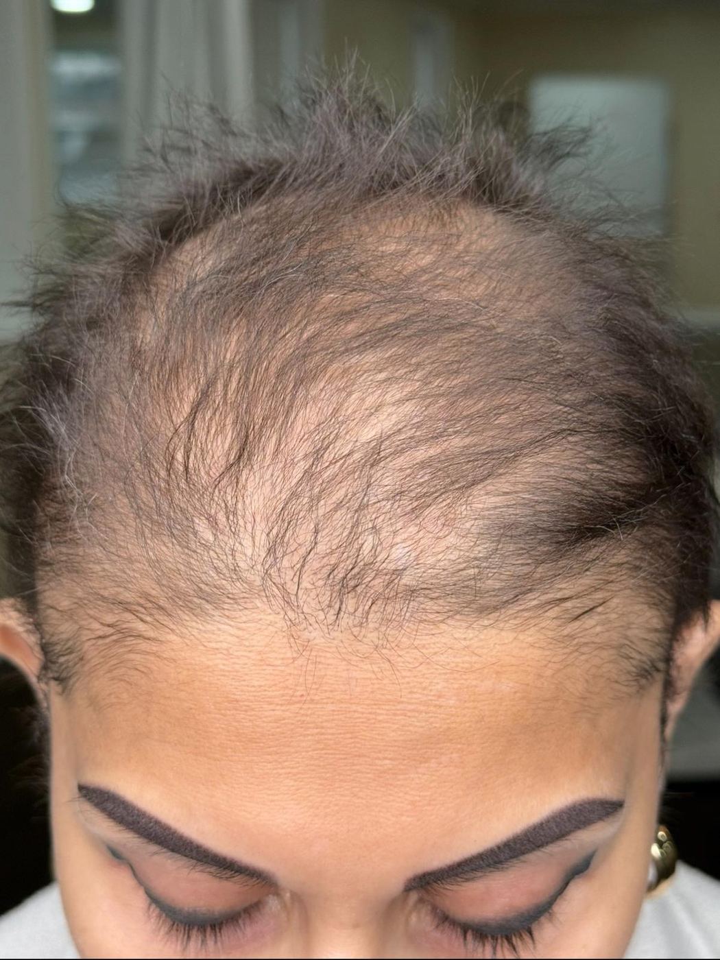 Frontal hairline before hair follicle restoration, showing diffuse thinning