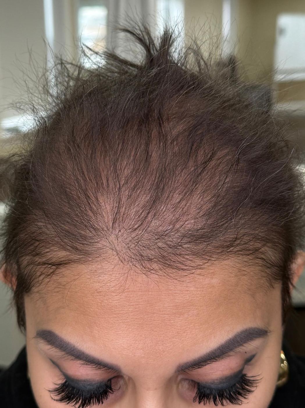 Frontal hairline after hair follicle restoration