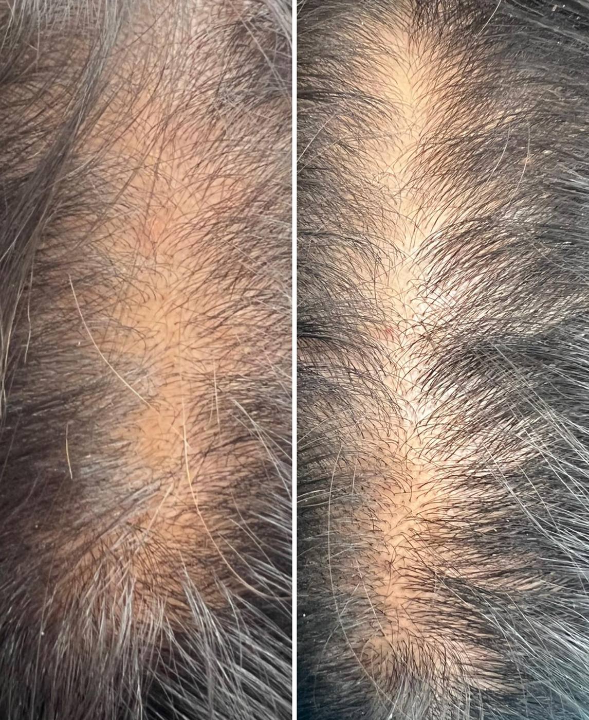 Hair follicle restoration before and after along the part line