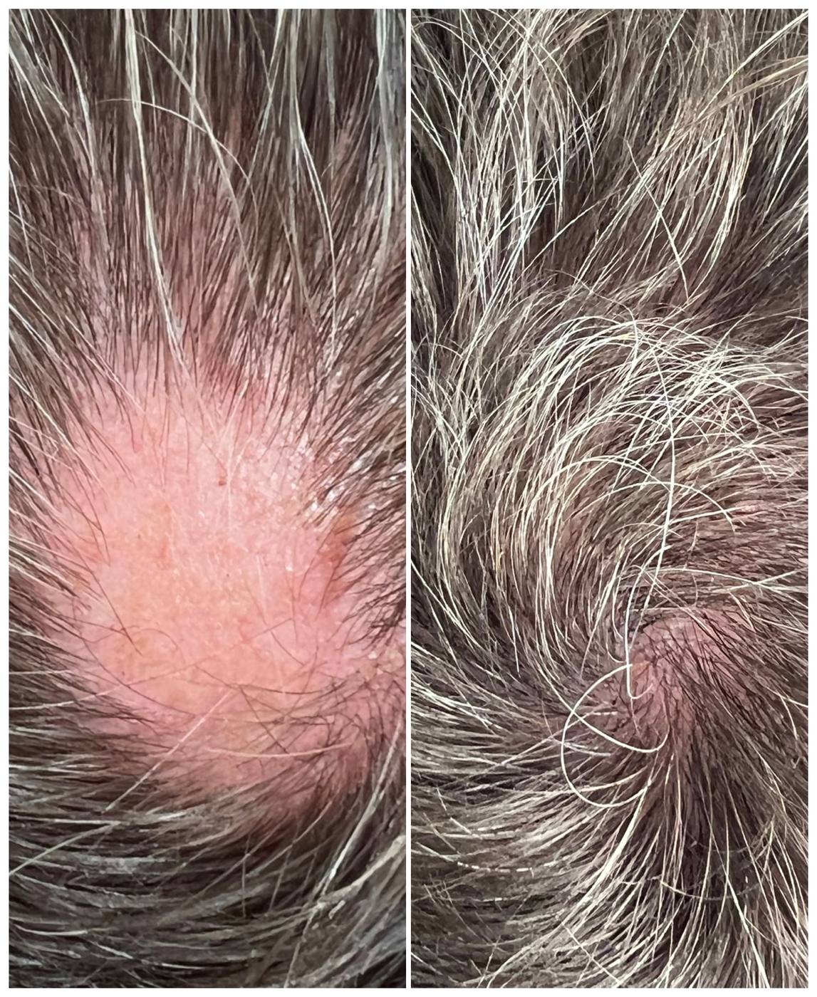 Hair follicle restoration before and after on a patchy area of the crown