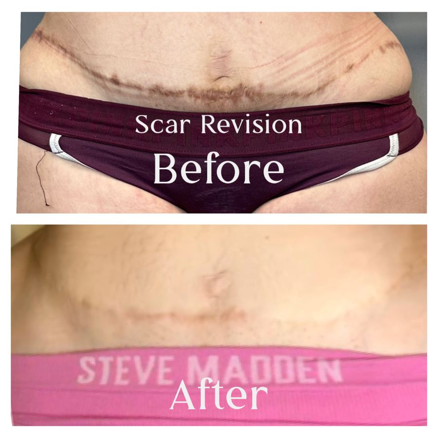 Scar revision before and after on a tummy tuck scar
