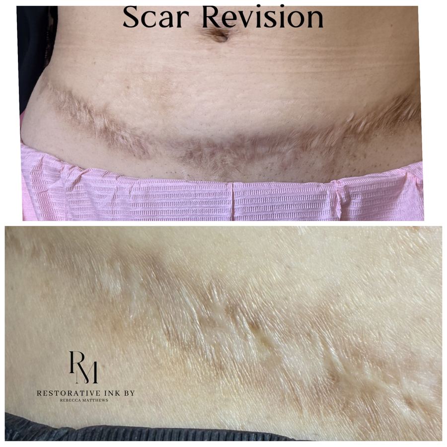 Hip scar revision before and after