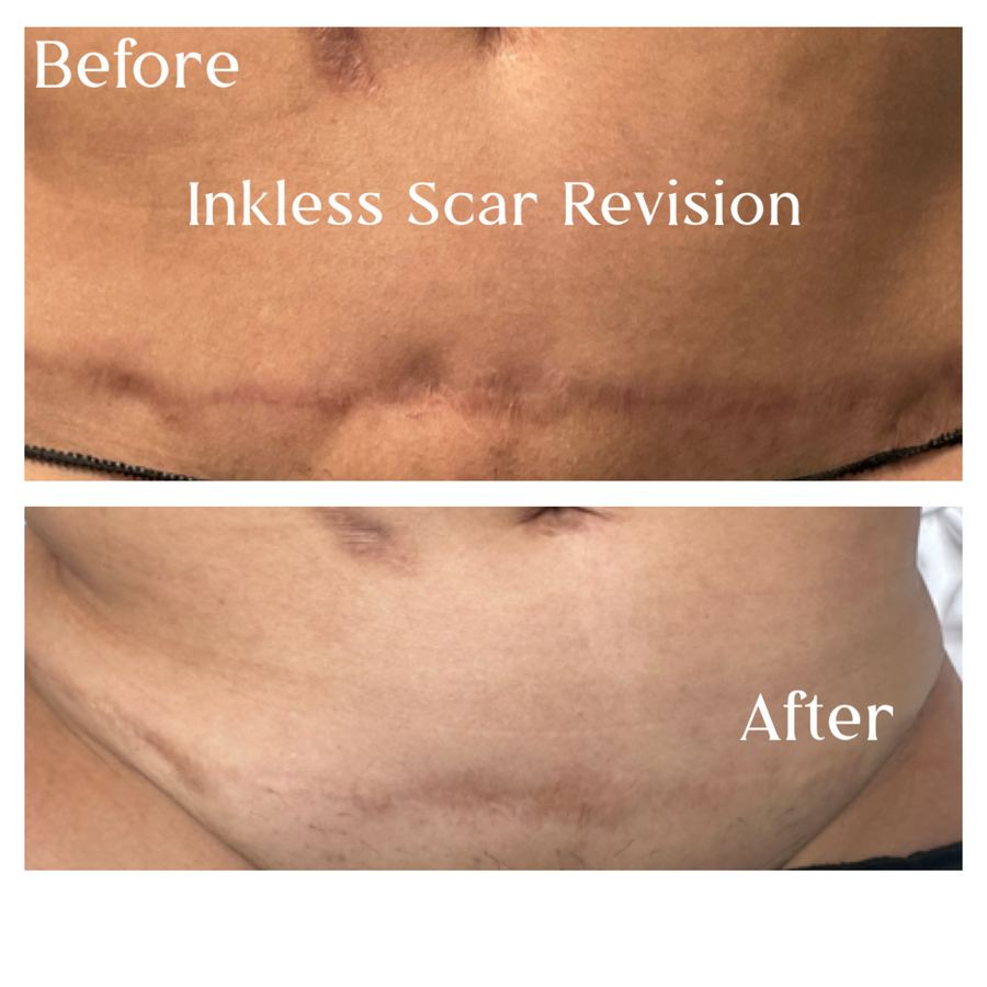 Inkless scar revision before and after on melanin-rich skin