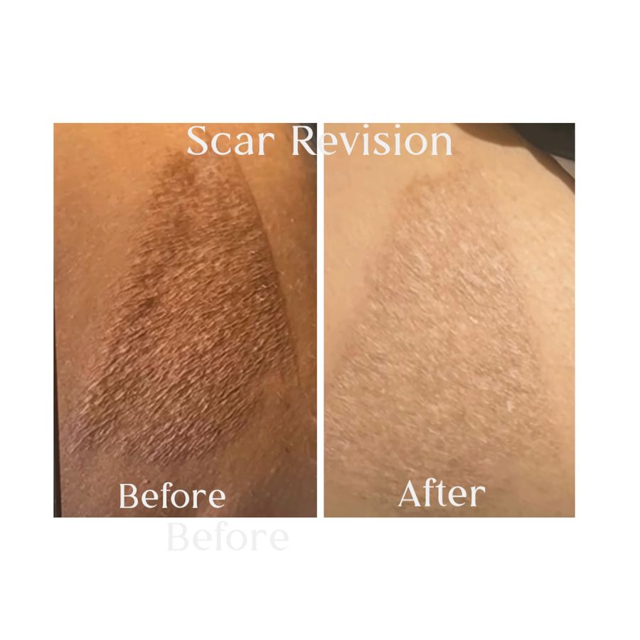 Dark scar revision before and after on deep skin tone