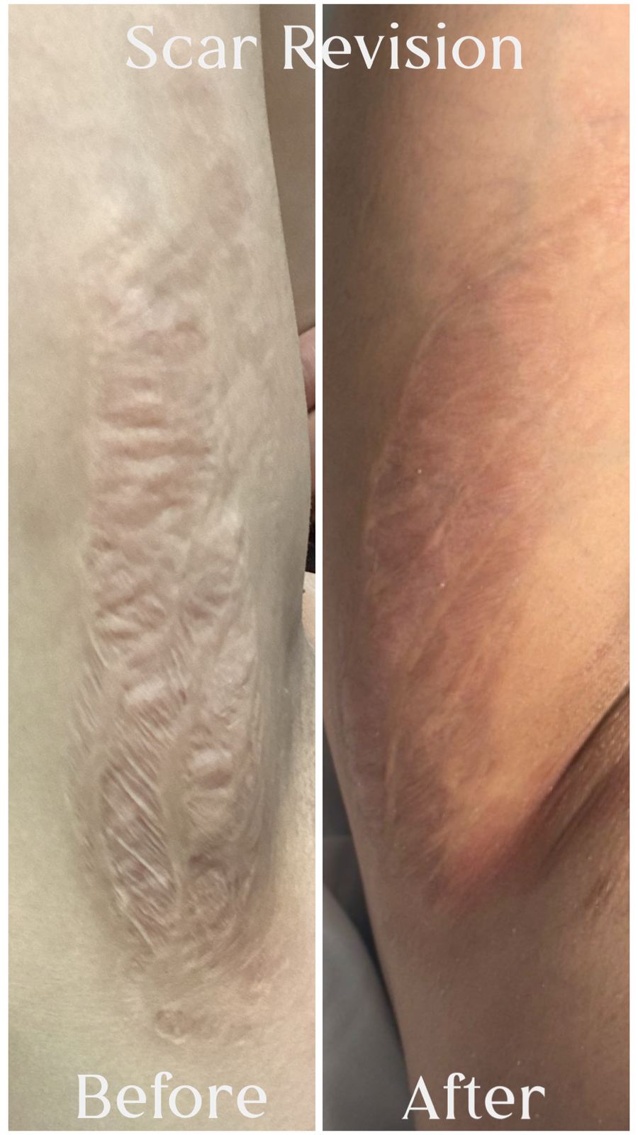 Textured scar revision before and after