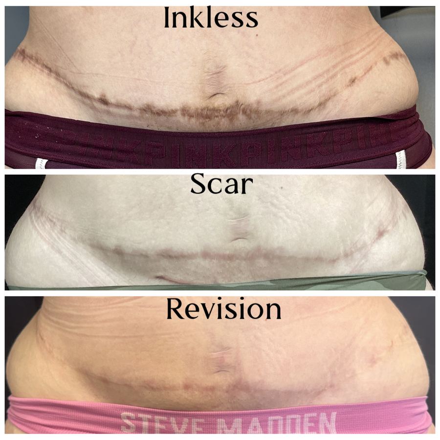 Inkless scar revision three-stage progression