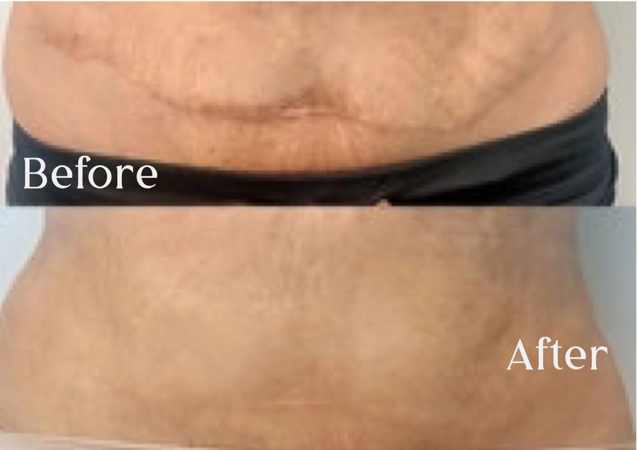 C-section scar revision before and after