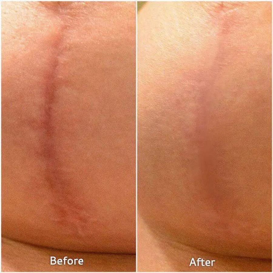 Breast augmentation scar revision before and after