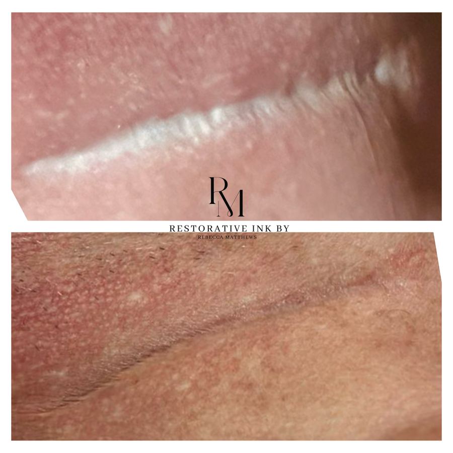 Inframammary scar revision close-up, before and after