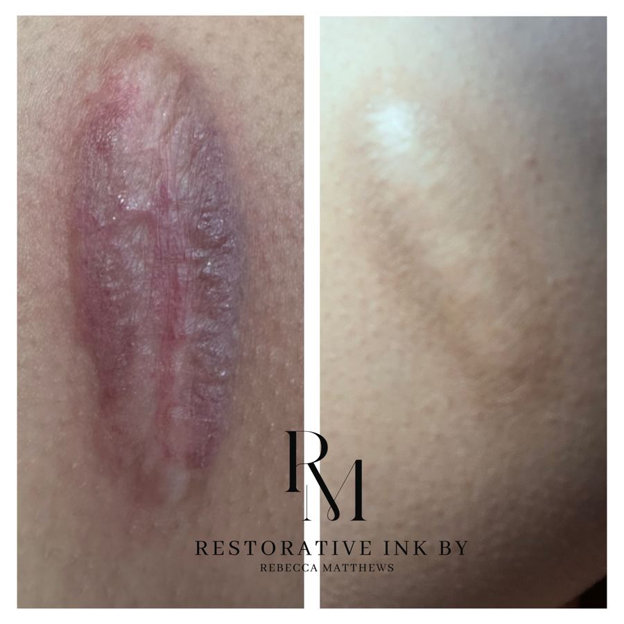 Raised dark scar revision before and after