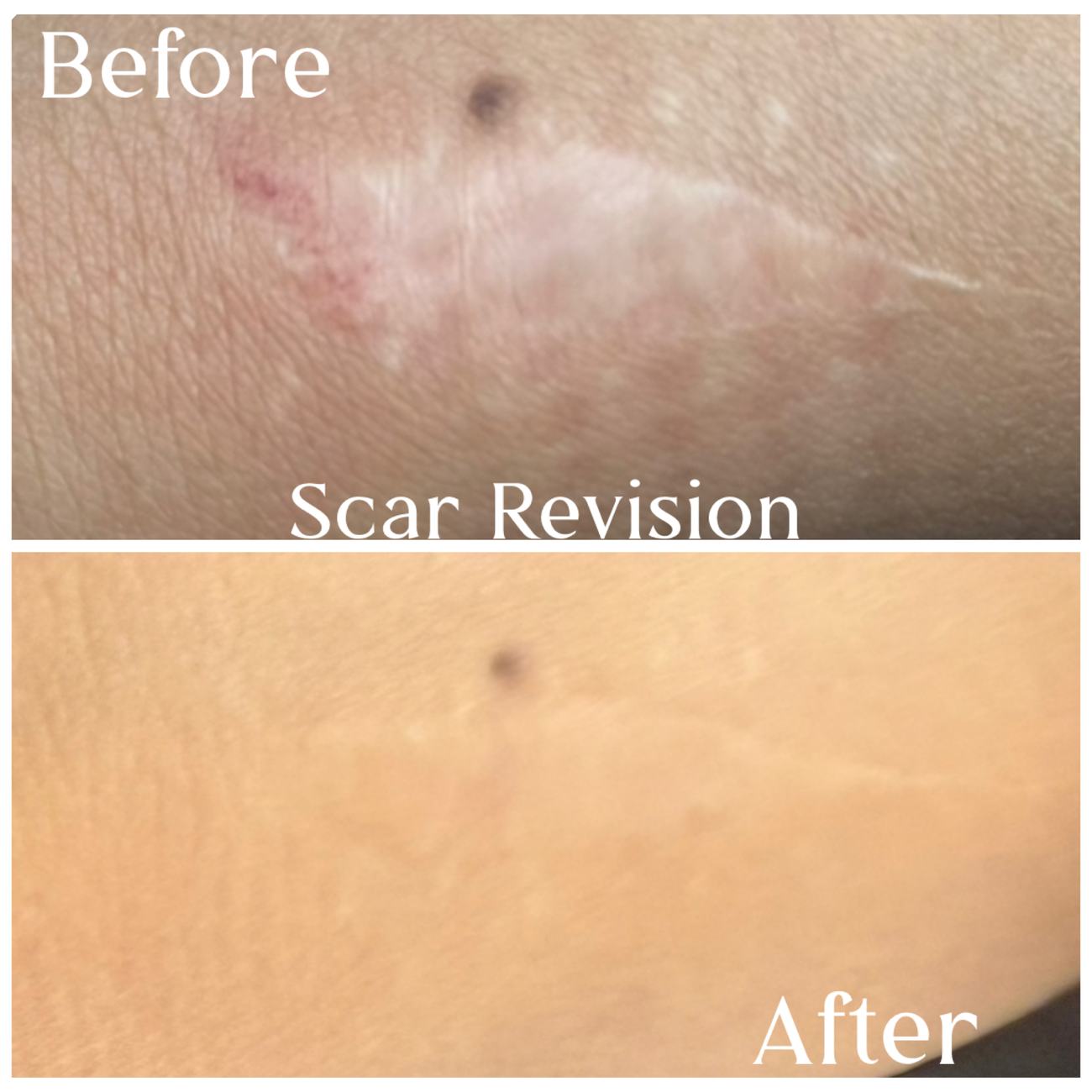 Raised hypopigmented scar on the arm, before and after revision
