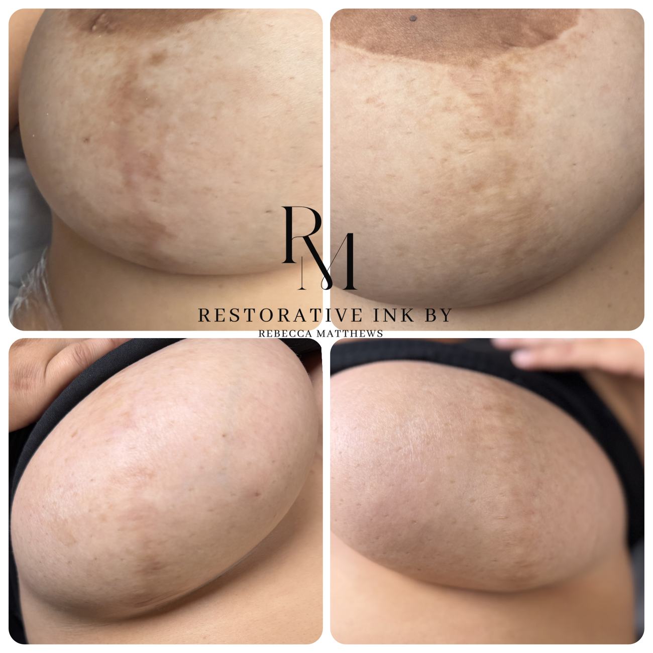 Breast scarring and pigmentation revision, shown from four angles