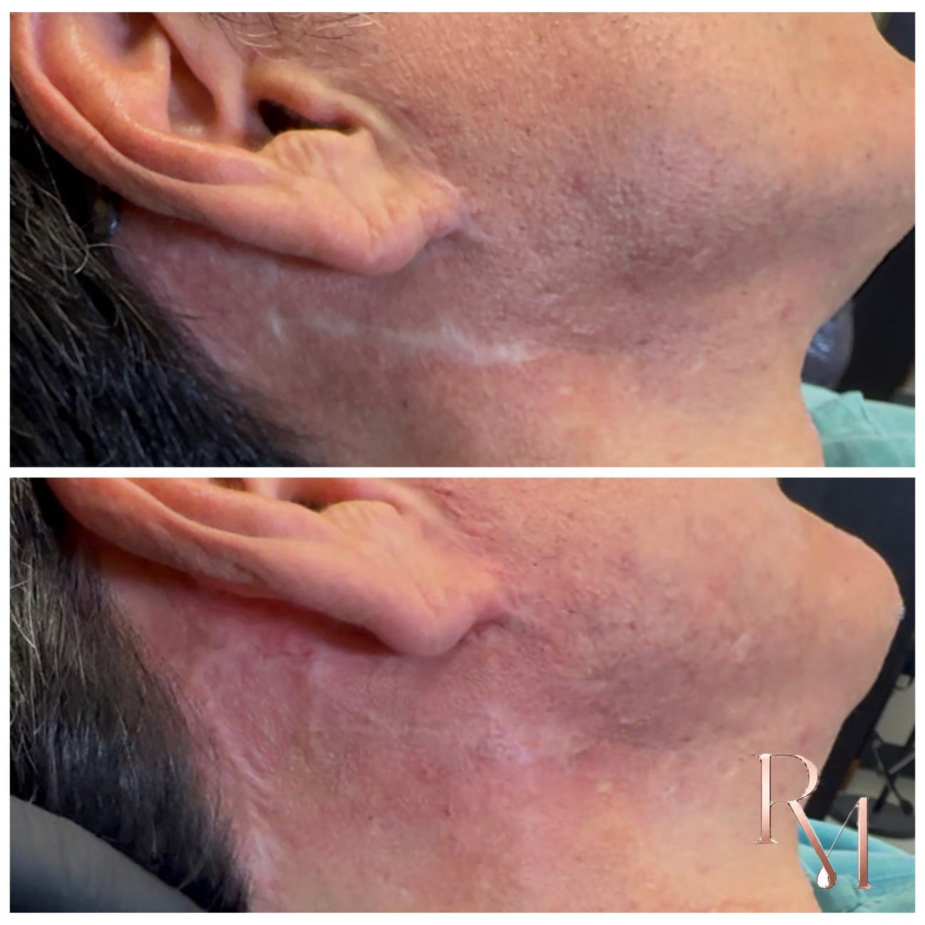 Jawline and neck surgical scar, before and after revision