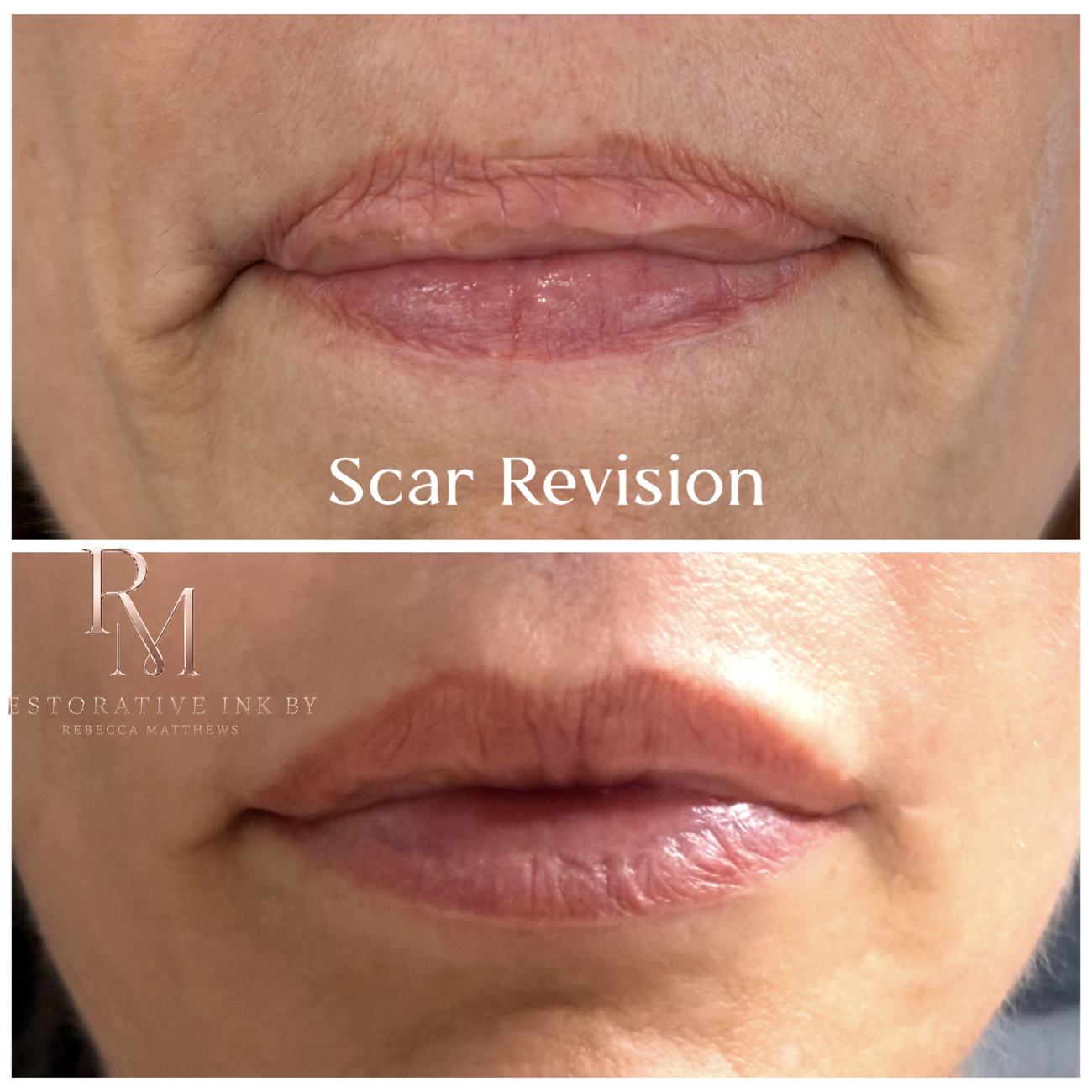 Lip and perioral scar revision, before and after