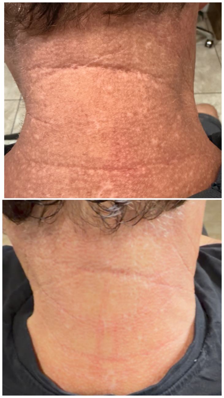 Extensive raised and hypopigmented scarring on the neck, before and after camouflage and revision