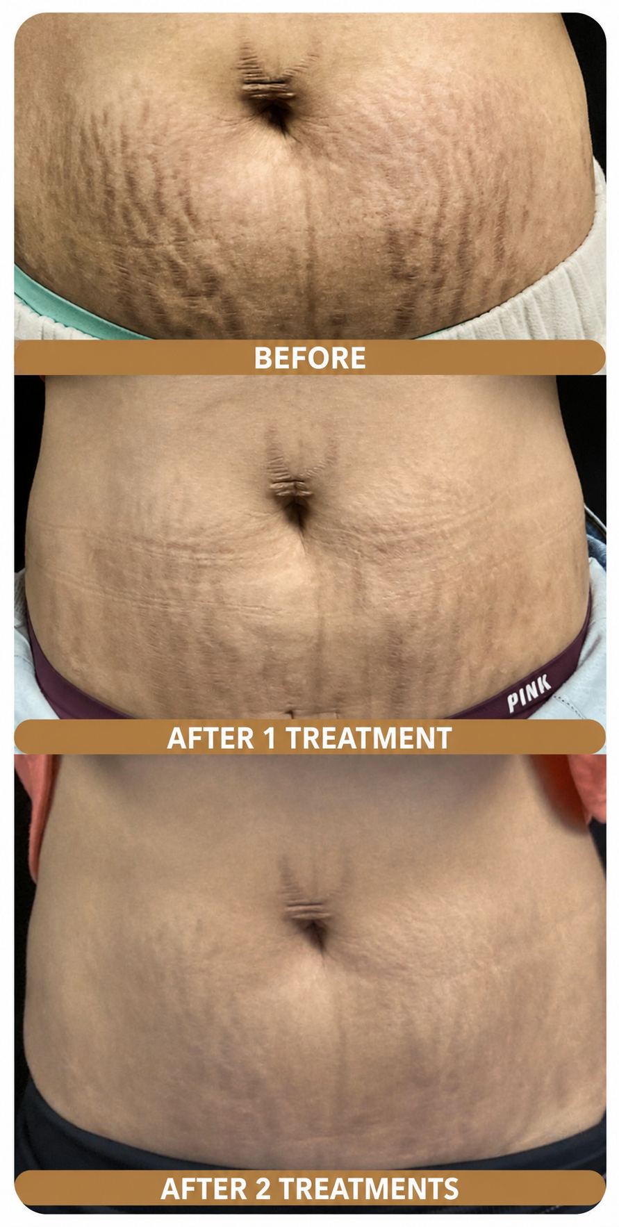Stretch mark revision on melanin-rich skin: before, after one treatment, after two treatments