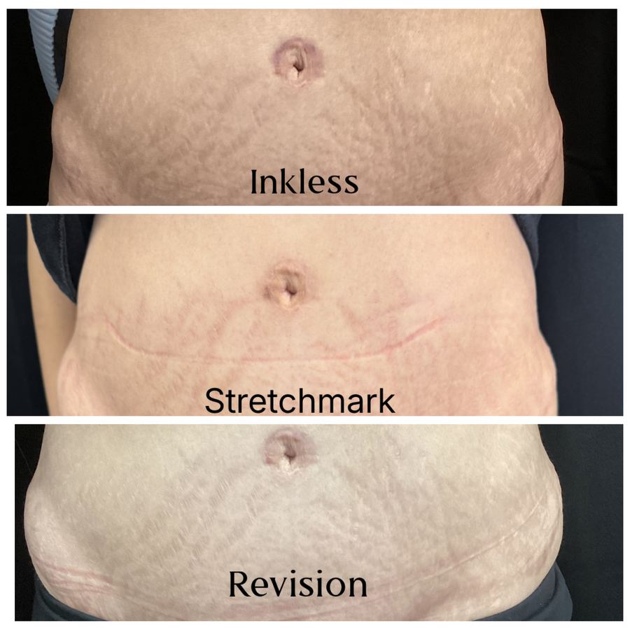 Inkless stretch mark revision three-stage progression