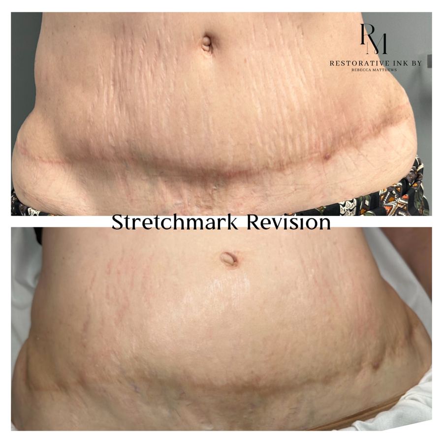 Stretch mark revision on the abdomen, before and after