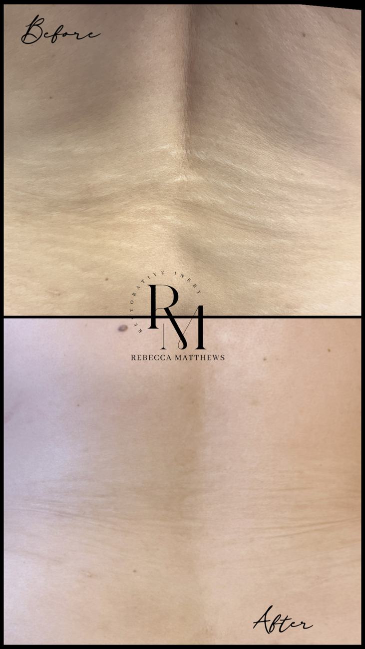 Stretch mark camouflage on the chest and decolletage, before and after