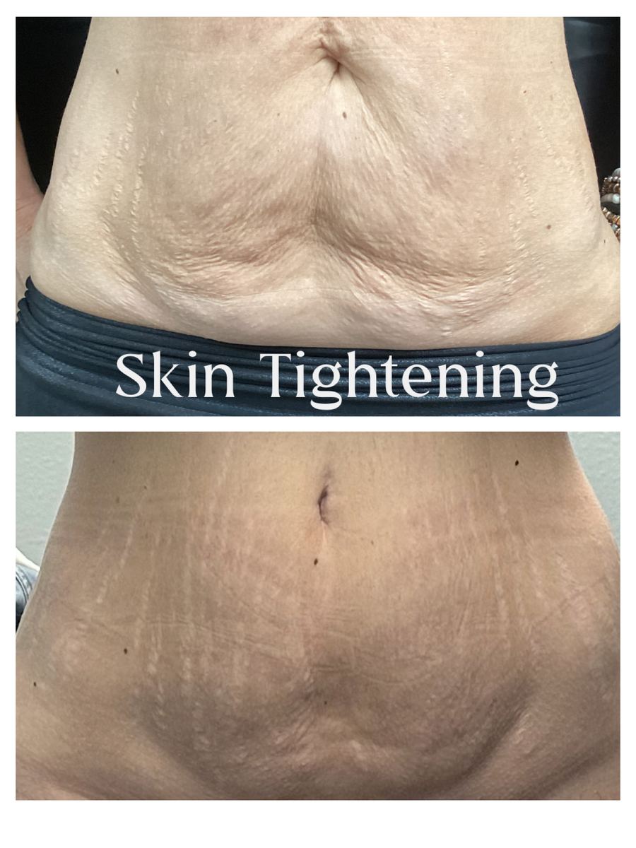 Skin tightening before and after on the abdomen